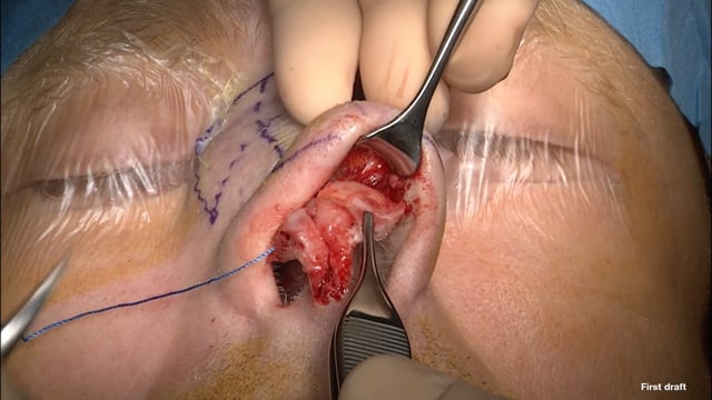 Deviazione del setto nasale in esiti da trauma