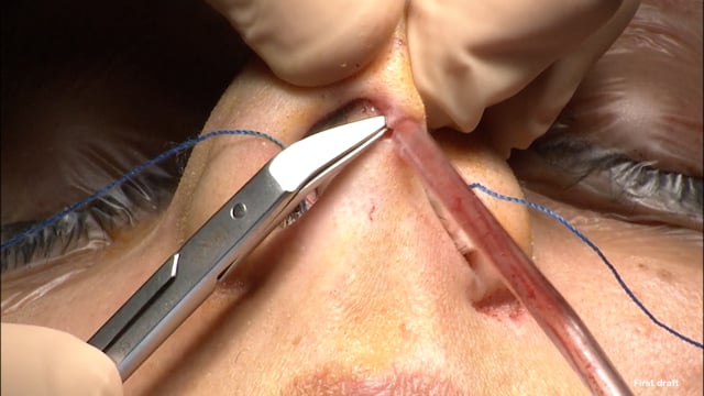 Deviazione del setto nasale in esiti da trauma