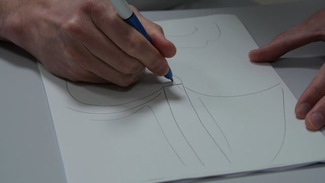 Visita ambulatoriale per adenocarcinoma dell'esofago e descrizione dell'intervento chirurgico