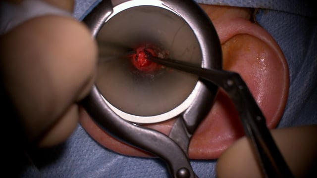 Intervento di ossiculoplastica