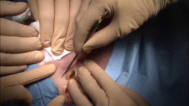 Intervento di parotidectomia destra