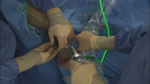 Ricostruzione del legamento crociato anteriore