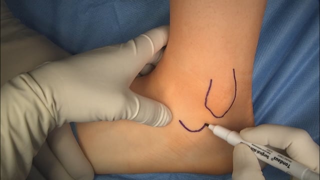 Trattamento chirurgico della patologia del piede piatto pediatrico