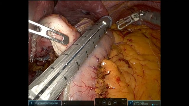 Trattamento chirurgico robotico del cancro dell'esofago secondo la tecnica Ivor Lewis Ramie