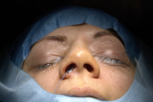 Deviazione del setto nasale in esiti da trauma