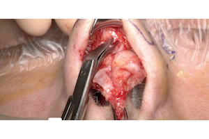 Deviazione del setto nasale in esiti da trauma