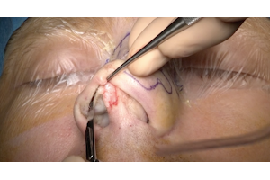 Crooked nose deformity - 24° SICMF congress 13 June 2025
