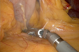 Trattamento chirurgico robotico del cancro dell'esofago secondo la tecnica Ivor Lewis Ramie