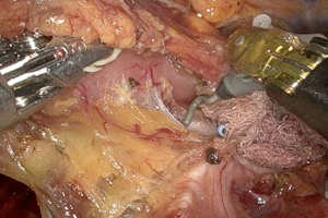 Isolamento dell'esofago toracico con tecnica robotica