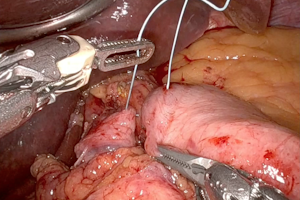 Plastica antireflusso robotica secondo Nissen Rossetti