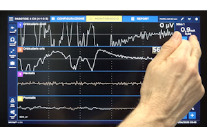 Intervento di parotidectomia destra