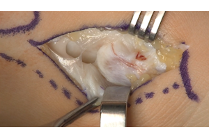 Trattamento chirurgico della patologia del piede piatto pediatrico